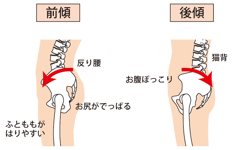 骨盤のゆがみ説明